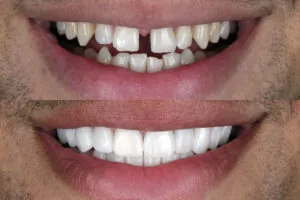 Closure of Separated Teeth