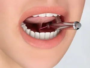 Tongue & Lip Tie Removal