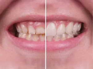 Gummy Smile Treatment