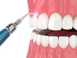 Gum Pigmentation Treatment