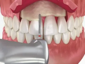 Gingivectomy & Gingivoplasty