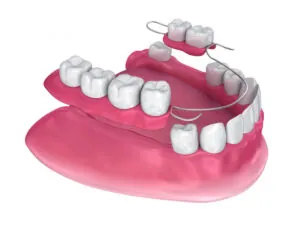 Removable Dentures