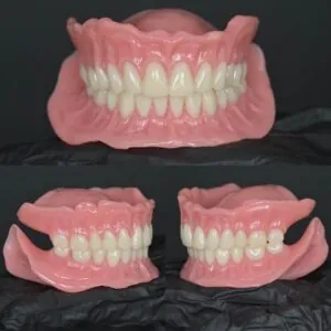Full Denture – Vacuum Effect