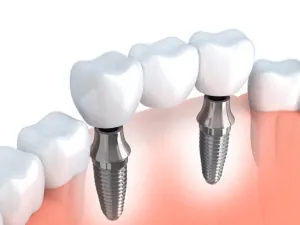 Implant Supported Restorations