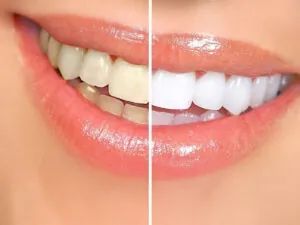 Composite Laminate
