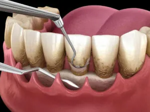 Curettage – Deep Cleaning