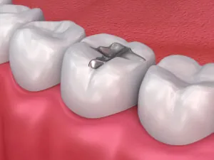 Porcelain Filling