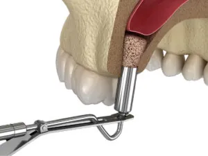Sinus-lift Operation