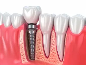 Implant Treatment