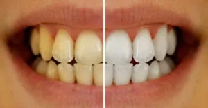 Teeth Whitening