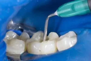 Filling Treatment