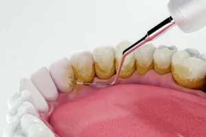 Tartar Cleaning & Airflow Application