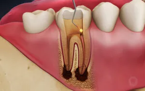 Root Canal Treatment