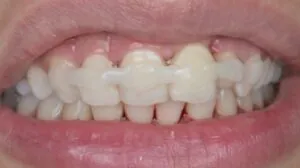 Splint Tedavisi